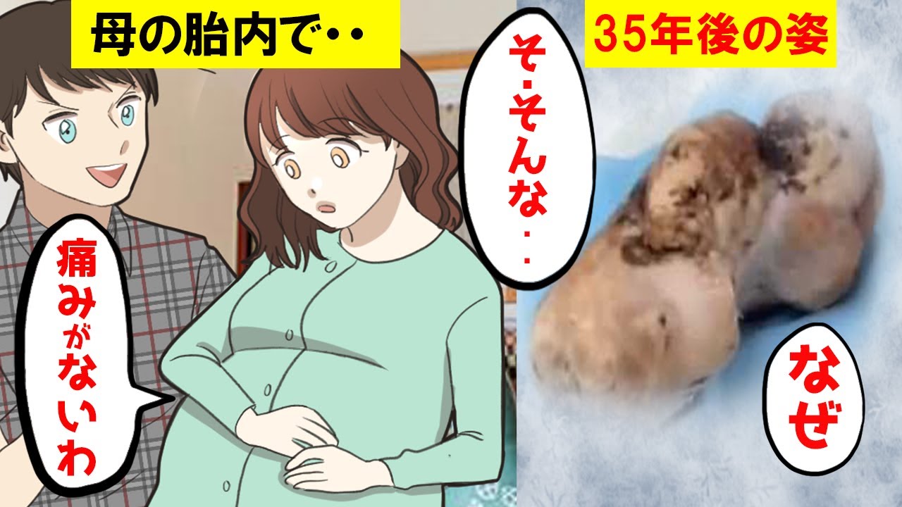 (実話漫画)母親の胎内で35歳になって産まれたストーンベビーの謎…